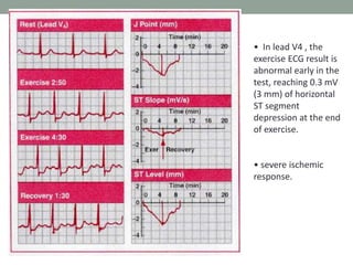 • In lead V4 , the
exercise ECG result is
abnormal early in the
test, reaching 0.3 mV
(3 mm) of horizontal
ST segment
depression at the end
of exercise.
• severe ischemic
response.
 