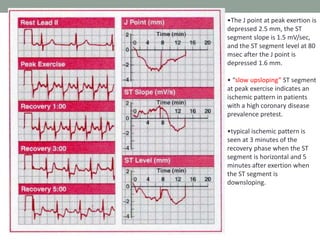 •The J point at peak exertion is
depressed 2.5 mm, the ST
segment slope is 1.5 mV/sec,
and the ST segment level at 80
msec after the J point is
depressed 1.6 mm.
• “slow upsloping” ST segment
at peak exercise indicates an
ischemic pattern in patients
with a high coronary disease
prevalence pretest.
•typical ischemic pattern is
seen at 3 minutes of the
recovery phase when the ST
segment is horizontal and 5
minutes after exertion when
the ST segment is
downsloping.
 