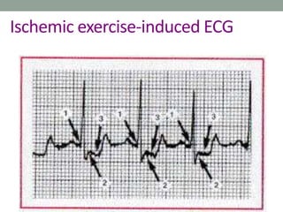 Ischemic exercise-induced ECG
 