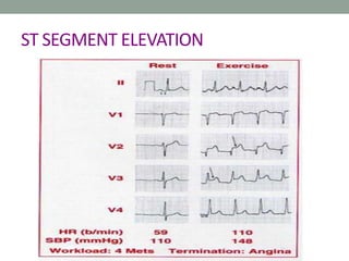 ST SEGMENT ELEVATION
 