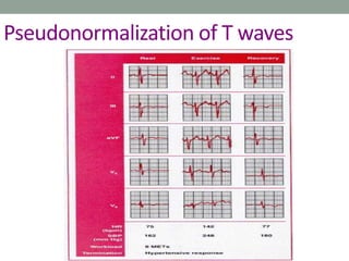 Pseudonormalization of T waves
 