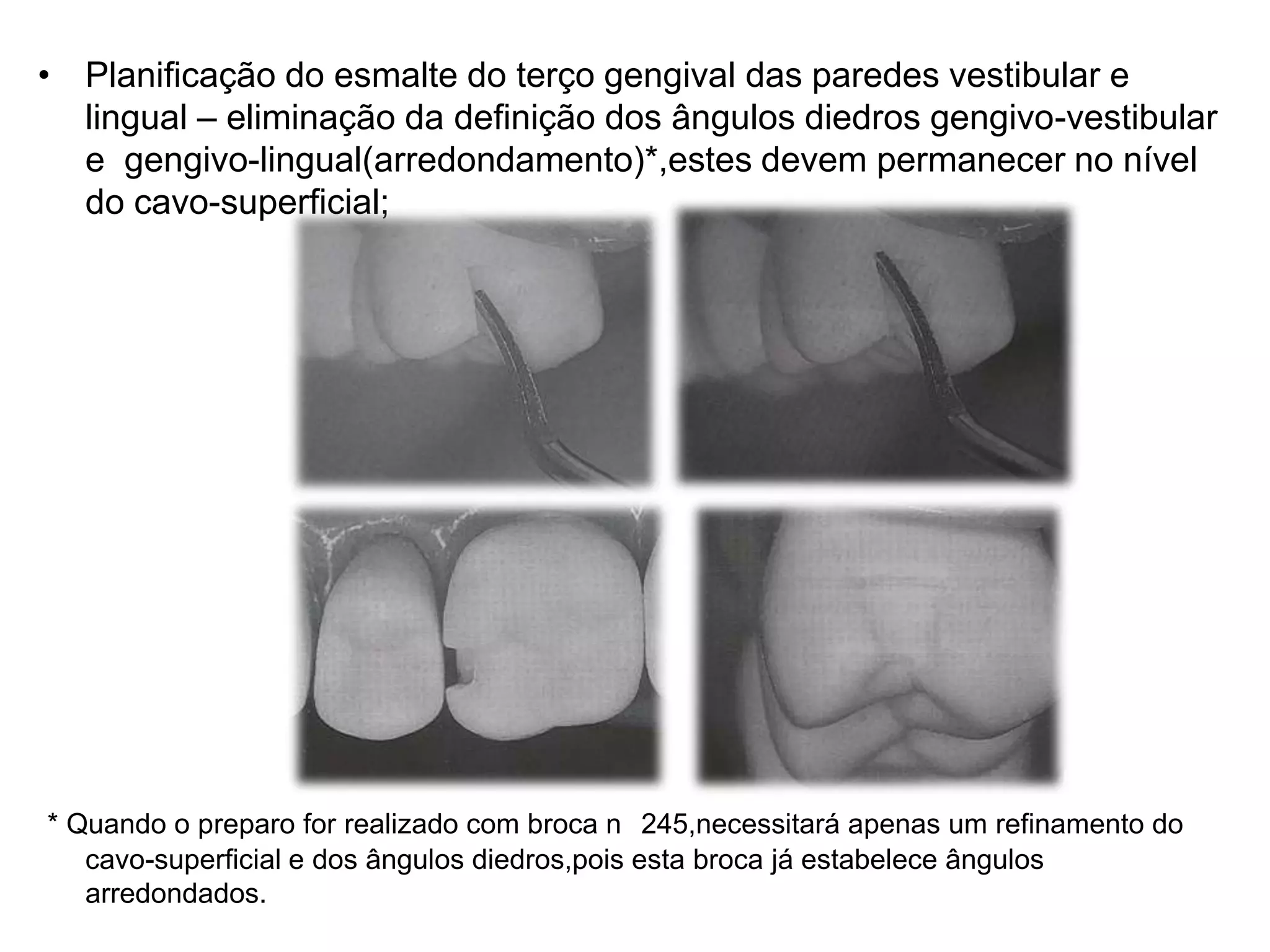 • Planificação do esmalte do terço gengival das paredes vestibular e
  lingual – eliminação da definição dos ângulos diedros gengivo-vestibular
  e gengivo-lingual(arredondamento)*,estes devem permanecer no nível
  do cavo-superficial;




* Quando o preparo for realizado com broca n 245,necessitará apenas um refinamento do
   cavo-superficial e dos ângulos diedros,pois esta broca já estabelece ângulos
   arredondados.
 