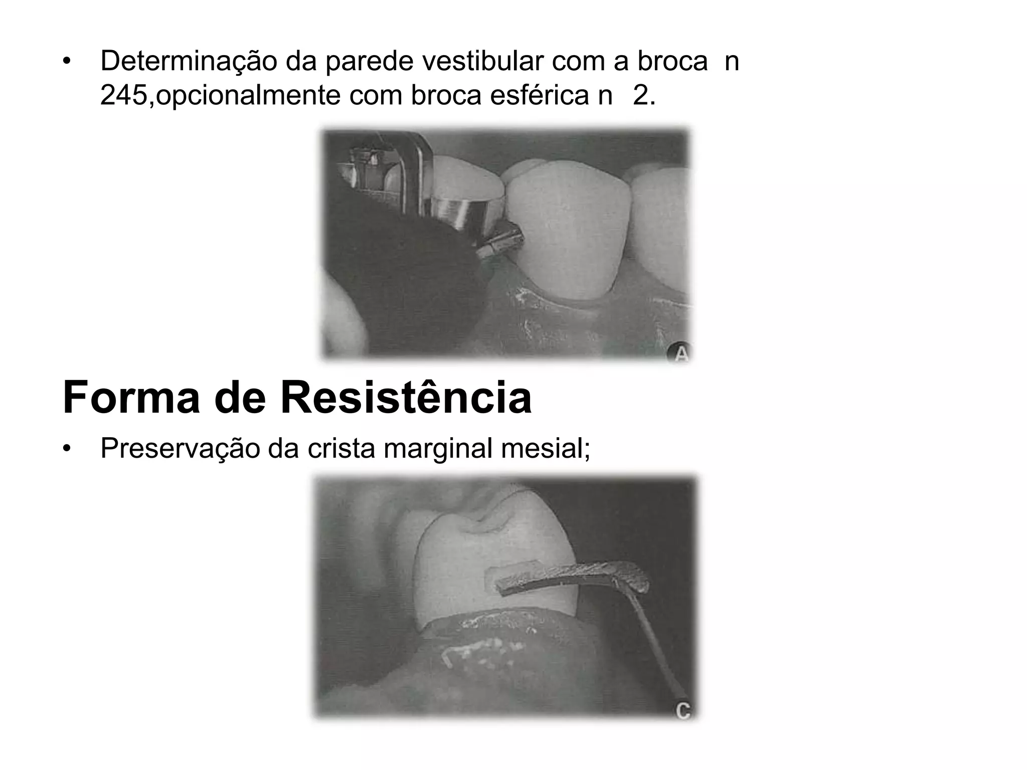 • Determinação da parede vestibular com a broca n
  245,opcionalmente com broca esférica n 2.




Forma de Resistência
• Preservação da crista marginal mesial;
 