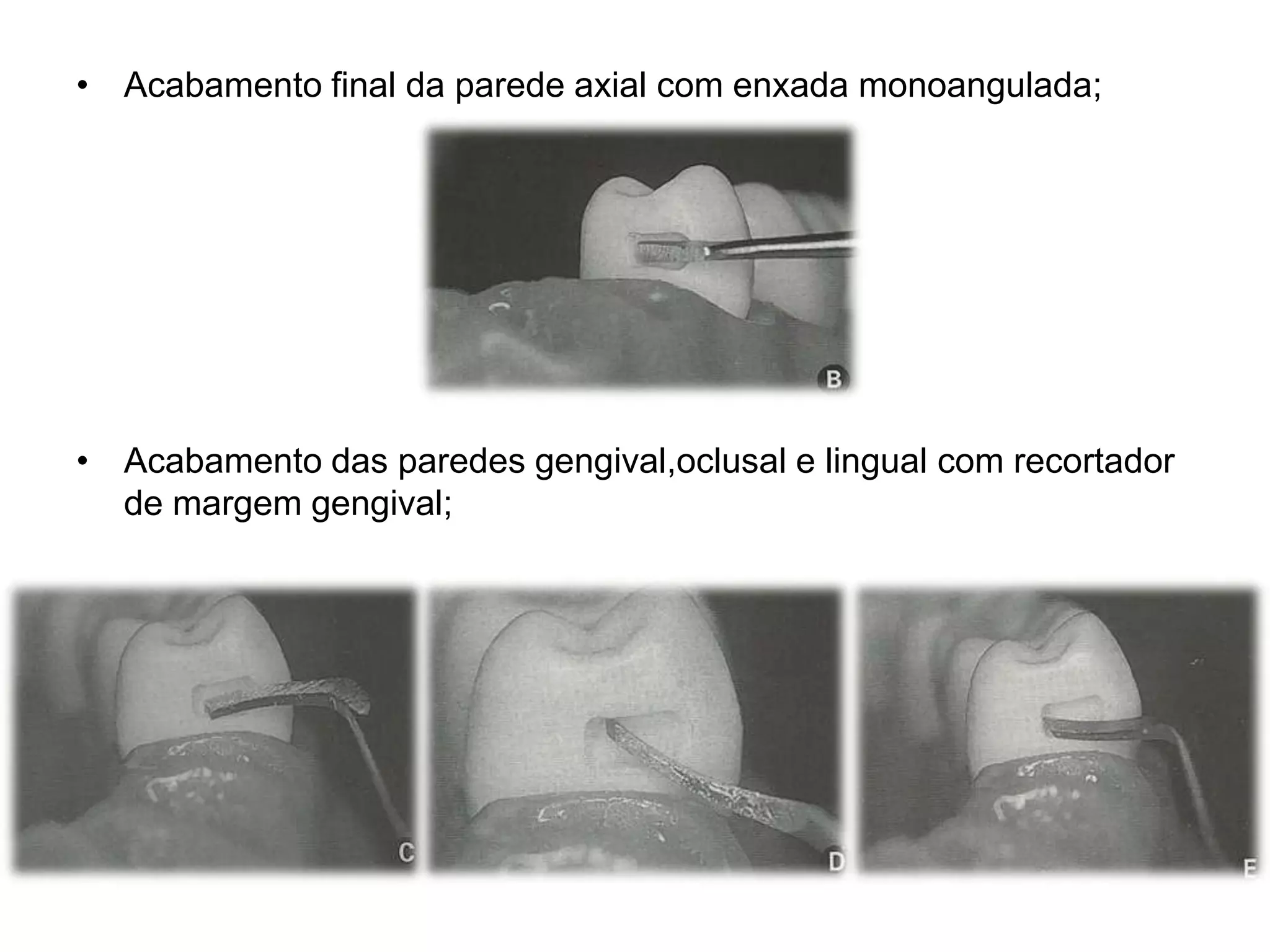 • Acabamento final da parede axial com enxada monoangulada;




• Acabamento das paredes gengival,oclusal e lingual com recortador
  de margem gengival;
 