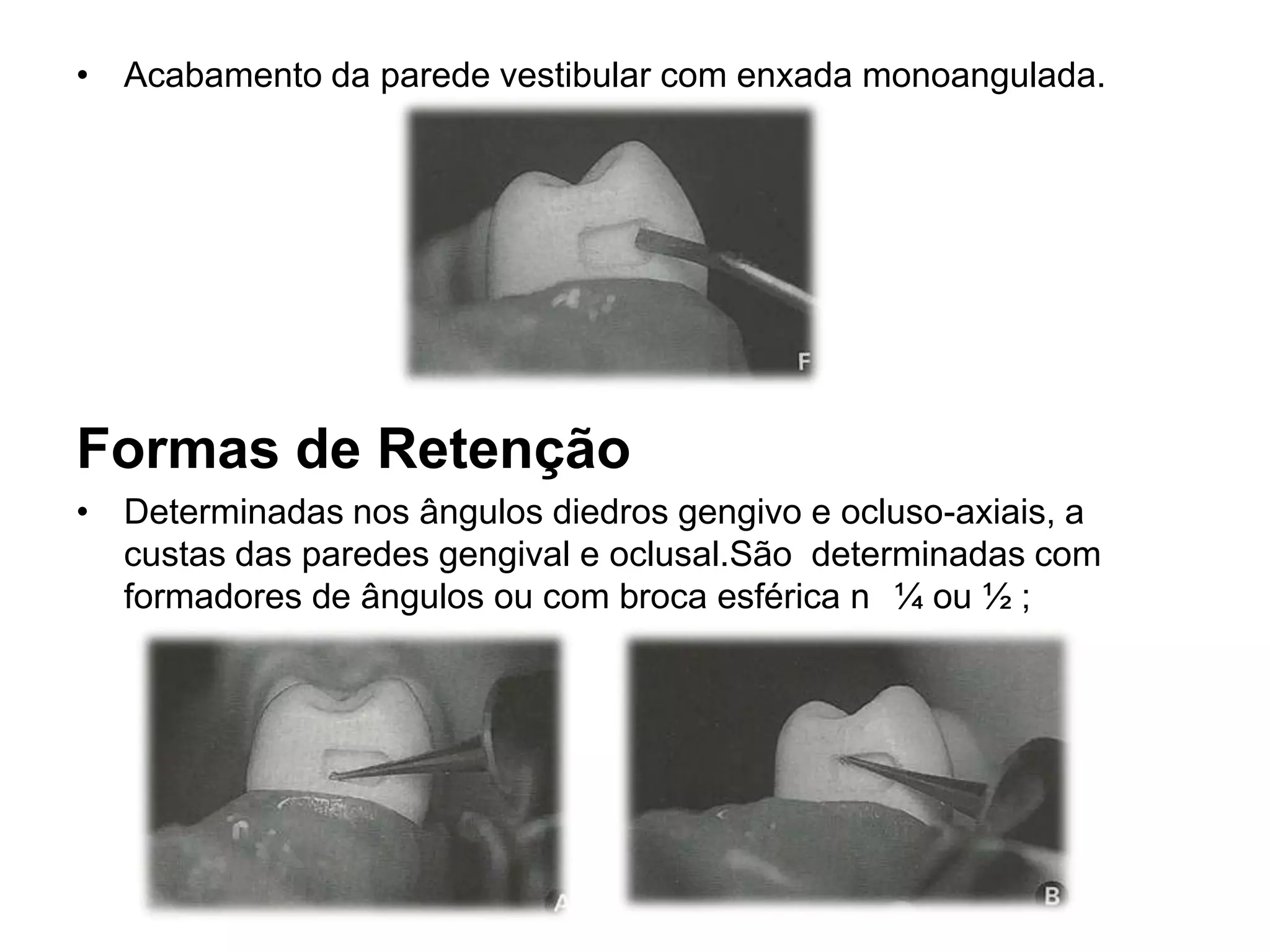 • Acabamento da parede vestibular com enxada monoangulada.




Formas de Retenção
• Determinadas nos ângulos diedros gengivo e ocluso-axiais, a
  custas das paredes gengival e oclusal.São determinadas com
  formadores de ângulos ou com broca esférica n ¼ ou ½ ;
 