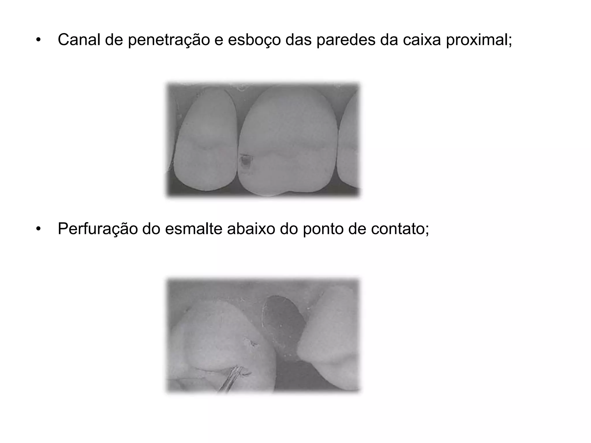 • Canal de penetração e esboço das paredes da caixa proximal;




• Perfuração do esmalte abaixo do ponto de contato;
 