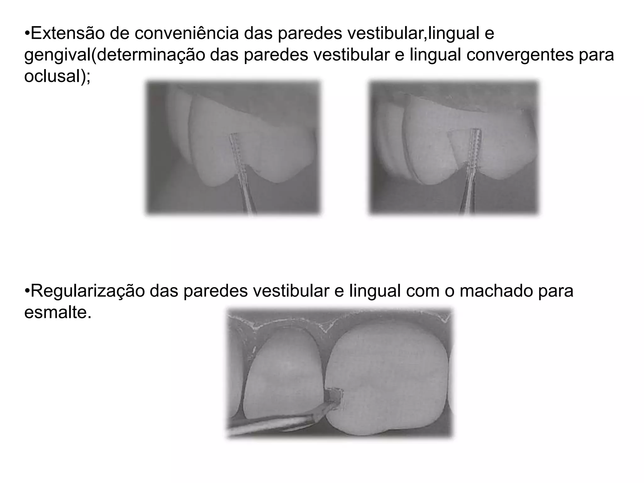•Extensão de conveniência das paredes vestibular,lingual e
gengival(determinação das paredes vestibular e lingual convergentes para
oclusal);




•Regularização das paredes vestibular e lingual com o machado para
esmalte.
 
