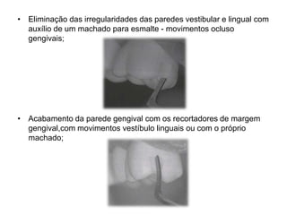 • Eliminação das irregularidades das paredes vestibular e lingual com
  auxílio de um machado para esmalte - movimentos ocluso
  gengivais;




• Acabamento da parede gengival com os recortadores de margem
  gengival,com movimentos vestíbulo linguais ou com o próprio
  machado;
 
