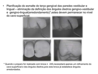 • Planificação do esmalte do terço gengival das paredes vestibular e
  lingual – eliminação da definição dos ângulos diedros gengivo-vestibular
  e gengivo-lingual(arredondamento)*,estes devem permanecer no nível
  do cavo-superficial;




* Quando o preparo for realizado com broca n 245,necessitará apenas um refinamento do
   cavo-superficial e dos ângulos diedros,pois esta broca já estabelece ângulos
   arredondados.
 