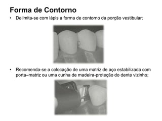 Forma de Contorno
• Delimita-se com lápis a forma de contorno da porção vestibular;




• Recomenda-se a colocação de uma matriz de aço estabilizada com
  porta–matriz ou uma cunha de madeira-proteção do dente vizinho;
 