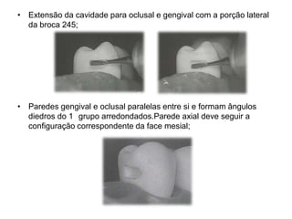 • Extensão da cavidade para oclusal e gengival com a porção lateral
  da broca 245;




• Paredes gengival e oclusal paralelas entre si e formam ângulos
  diedros do 1 grupo arredondados.Parede axial deve seguir a
  configuração correspondente da face mesial;
 