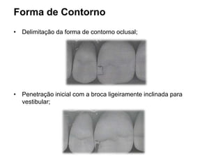 Forma de Contorno
• Delimitação da forma de contorno oclusal;




• Penetração inicial com a broca ligeiramente inclinada para
  vestibular;
 