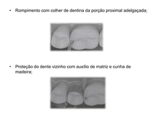 • Rompimento com colher de dentina da porção proximal adelgaçada;




• Proteção do dente vizinho com auxílio de matriz e cunha de
  madeira;
 