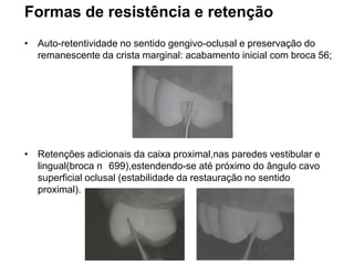 Formas de resistência e retenção
• Auto-retentividade no sentido gengivo-oclusal e preservação do
  remanescente da crista marginal: acabamento inicial com broca 56;




• Retenções adicionais da caixa proximal,nas paredes vestibular e
  lingual(broca n 699),estendendo-se até próximo do ângulo cavo
  superficial oclusal (estabilidade da restauração no sentido
  proximal).
 