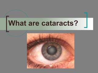 What are cataracts? 