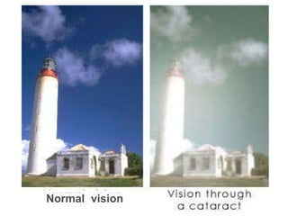 _____ _____ _____ _____ Normal  vision  