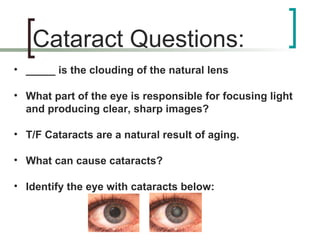 Cataract Questions: _____ is the clouding of the natural lens What part of the eye is responsible for focusing light and producing clear, sharp images? T/F Cataracts are a natural result of aging. What can cause cataracts? Identify the eye with cataracts below: 