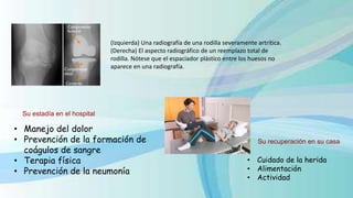 Su estadía en el hospital
• Manejo del dolor
• Prevención de la formación de
coágulos de sangre
• Terapia física
• Prevención de la neumonía
Su recuperación en su casa
• Cuidado de la herida
• Alimentación
• Actividad
(Izquierda) Una radiografía de una rodilla severamente artrítica.
(Derecha) El aspecto radiográfico de un reemplazo total de
rodilla. Nótese que el espaciador plástico entre los huesos no
aparece en una radiografía.
 