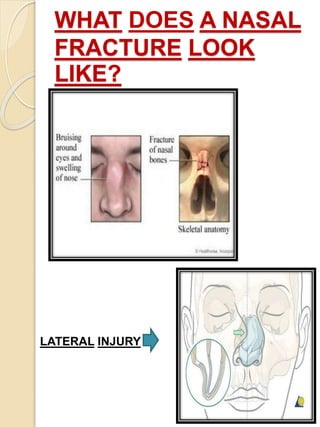 WHAT DOES A NASAL
FRACTURE LOOK
LIKE?
LATERAL INJURY
 