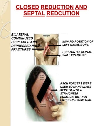 CLOSED REDUCTION AND
SEPTAL REDCUTION
INWARD ROTATION OF
LEFT NASAL BONE.
HORIZONTAL SEPTAL
WALL FRACTURE
BILATERAL
COMMINUTED
DISPLACED AND
DEPRESSED NASAL
FRACTURES
ASCH FORCEPS WERE
USED TO MANIPULATE
SEPTUM INTO A
STRAIGHTER
POSITION, BUT NOT
ENTIRELY SYMMETRIC.
 