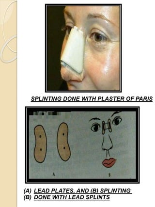 SPLINTING DONE WITH PLASTER OF PARIS
(A) LEAD PLATES, AND (B) SPLINTING
(B) DONE WITH LEAD SPLINTS
 