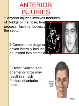 ANTERIOR
INJURIES
1.Anterior injuries involves fractures
of bridge of the nose, frontal
process, lacrimal bones, and
the septum.
2.Comminuted fragments may be
driven laterally into the orbit
or upward into ethmoid region.
3.Direct, violent, and/
or anterior force may
result in smash
fracture of anterior
bone.
 