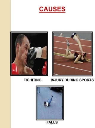 FIGHITING
CAUSES
INJURY DURING SPORTS
FALLS
 