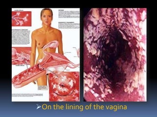 On the lining of the vagina
 