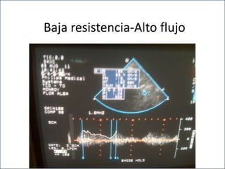 Baja resistencia-Alto flujo
 
