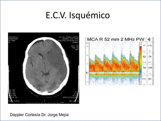 E.C.V. Isquémico
Doppler Cortesía Dr. Jorge Mejía
 