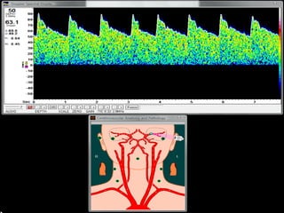 ene
2008
dic
2008
Epidemiológicas
Clínicas
Quirúrgicas
De laboratorio
De tratamiento
Se excluyeron pacientes con implante de material de osteosíntesis
(tiempo para infección de sitio operatorio hasta un año)
 