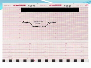 DESACELERACION PROLONGADA


     >15LPM X > DE
     2 A 10 MIN
 