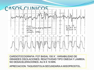 CASOS CLINICOS




 CARDIOTOCOGRAFIA: FCF BASAL 150 X´. VARIABILIDAD DE
 GRANDES OSCILACIONES. REACTIVIDAD TIPO OMEGA Y LAMBDA.
 NO DESACELERACIONES. AU 8 X 10 MIN.
 APRECIACION: TAQUISISTOLIA SECUNDARIA A MISOPROSTOL.
 