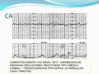 CASOS CLINICOS




 CARDIOTOCOGRAFIA: FCF BASAL 150 X´. VARIABILIDAD DE
 MEDIANAS OSCILACIONES. REACTIVIDAD TIPO OMEGA Y
 LAMBDA. 1 DESACELERACION TIPO ESPICA. AU IRREGULAR
 CADA 7 MINUTOS.
 