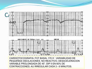 CASOS CLINICOS




 CARDIOTOCOGRAFIA: FCF BASAL 170 X´. VARIABILIDAD DE
 PEQUEÑAS OSCILACIONES. NO REACTIVO. DESACELERACION
 VARIABLE PROLONGADA DE 45”. DIP II EN 60% DE
 CONTRACCIONES. AU IRREGULAR CADA 3 - 6 MINUTOS.
 