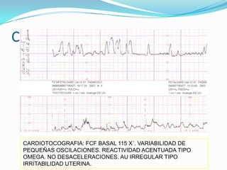 CASOS CLINICOS




 CARDIOTOCOGRAFIA: FCF BASAL 115 X´. VARIABILIDAD DE
 PEQUEÑAS OSCILACIONES. REACTIVIDAD ACENTUADA TIPO
 OMEGA. NO DESACELERACIONES. AU IRREGULAR TIPO
 IRRITABILIDAD UTERINA.
 