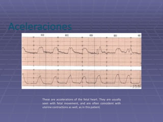 Monitoreo Electronico Fetal | PPT