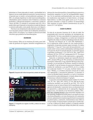 Volumen 36, Suplemento 1, abril-junio 2013
Álvarez-Reséndiz GE y cols. Monitoreo anestésico básico
S99
www.medigraphic.org.mx
Este documento es elaborado por Medigraphic
determinar en forma adecuada el estado y profundidad de la
hipnosis con un estado óptimo de anestesia e inconsciencia en
el paciente que se somete a un procedimiento quirúrgico. El
BIS y la entropía digitalizan la señal electroencefalográfica,
obteniéndose valores numéricos entre 0 (hipnosis y anestesia
profundas) y 100 (paciente despierto y consciente); cuando los
valores del BIS y la entropía se encuentran entre 40 y 60 se
puede inferir que el paciente se encuentra en estado de hipnosis
y anestesia adecuados, como puede observarse en la figura 6.
Para hacer una interpretación adecuada del estado de hipno-
sis es necesario conocer el efecto de los diferentes anestésicos
sobre el EEG. En la figura 7 es evidente el efecto de actividad
sincrónica que producen las benzodiacepinas.
DIURESIS
Gasto urinario: Debe ser un monitoreo de rutina como indi-
cador de perfusión de órganos, hemólisis mioglobinuria en
destrucción musculoesquelética, hemoglobinuria posterior a
transfusión sanguínea en caso de incompatibilidad sanguí-
nea. En los pacientes politraumatizados una causa común
de insuficiencia renal aguda es la hipovolemia y el choque
hipovolémico. La falla renal aguda ocurre en el 1% de los
pacientes sometidos a cirugía no cardíaca. El anestesiólogo
debe mantener un gasto urinario transanestésico de por lo
menos 0.5-1 mL/kg/hora.
CASO CLÍNICO
Se trata de un paciente femenino de 41 años de edad, fue
programada para resección quirúrgica de meningioma pa-
rietal derecho. No tiene antecedentes de importancia para la
anestesia y cirugía; el diagnóstico se realizó por resonancia
magnética de cráneo, la cual fue realizada por dolor de cabeza.
Paciente con Glasgow de 15, ASA IEB, Mallampati 1.
En la exploración, desde el punto de vista cardiovascular y
respiratorio, la paciente presentó signos normales. Se indica
midazolam 7.5 mg oral 1 hora antes del procedimiento, y se
instala catéter venoso central confirmándose radiológicamente
en la porción alta de la aurícula derecha. La paciente ingresa
a quirófano con Ramsay 3, TA 120/70, FC 60x›, SpO2 93%
ambiente, FR 16x›, PVC de 7, temperatura 36.6 ºC. Se coloca
monitor BIS 90; se lleva a cabo espirometría y capnografía.
Inducción, se administra oxígeno por mascarilla facial al
100%, atropina 500 ug, FC 90x› posterior a la administración
de atropina, midazolam 15 mg, tiopental 500 mg en dosis frac-
cionadas y en un período de 20 minutos, fentanyl en infusión
10 ug/Kg/h, 8 mg de bromuro de pancuronio después de 20
minutos de ventilación y con una FFECO2 de 16, se intuba
con sonda tipo Sanders 7.5 con guía, al primer intento con
hoja 3 McKoy, se corrobora situación correcta de la sonda
con capnografía y auscultación pulmonar. La paciente se
coloca en decúbito lateral izquierdo y se vuelve a corroborar
colocación de sonda endotraqueal; se instala sábana térmica.
Se disminuye infusión de fentanyl 2 ug/kg/h.
La paciente cursa hemodinámicamente estable TA 110/60
Torr, FC 70x›, SpO2 99%, EtCO2 22 Torr, BIS 40-50, bajo
ventilación mecánica con mezcla de gas FiO2 75%. En el
momento en que se retira el hueso de la craneotomía, previa
apertura de duramadre, la paciente inicia con disminución de
la capnometría y aplanamiento de la capnografía, llegando
hasta 6 Torr, con aumento en la frecuencia cardíaca 120x›,
PVC de 8, disminución en la cifras tensionales llegando a no
ser registrada, disminución de BIS hasta 6 con registro de trazo
electroencefalográfico, así como disminución en la saturación
arterial y aplanamiento de pletismografía hasta la ausencia de
la onda de pulso y saturación, manteniéndose trazo EKG en
155 por minuto. El neurocirujano comenta que el cerebro late,
y no hay evidencia de edema cerebral; se sospecha embolia
aérea, se coloca la cabeza por debajo del plano del corazón,
0 10 20 30 40 50 60 70 80 90 100
100
0
Probabilidad
de
hipnosis
adecuada
Figura 6. Esquema del índice de espectral y estado de hipnosis.
w
w
w
w
w
w
w
w
w
w
w
w
w
w
w
w
w
w
w
w
w
w
w
w
w
w
w
w
w
w
w
w
w
w
w
w
w
w
w
w
w
w
w
w
w
w
w
w
w
w
w
w
w
w
w
w
w
w
w
w
w
w
w
w
w
w
w
w
w
w
w
w
w
w
w
w
w
w
w
w
w
w
w
w
w
w
w
w
w
w
w
w
w
w
w
w
w
w
w
w
w
w
w
w
w
w
w
w
w
w
w
w
ww
w
w
w
w
w
w
w
w
w
w
w
w
w
w
w
w
w
w
w
w
w
w
w
w
w
w
w
w
w
w
w
w
w
w
w
w
w
w
w
w
w
w
w
w
w
w
w
w
w
w
w
w
w
w
w
w
w
w
w
w
w
w
w
w
w
w
w
w
w
w
w
w
w
w
w
w
w
w
w
w
w
w
w
w
w
w
w
w
w
w
w
w
w
w
w
w
w
w
w
w
w
w
w
w
w
w
w
w
w
w
w
w
w
w
w
w
w
w
w
w
w
w
w
w
w
w
w
w
w
w
w
w
w
w
w
w
w
w
w
w
w
w
w
w
w
w
w
w
w
w
w
w
w
w
w
w
w
w
w
w
w
w
w
w
w
w
w
w
w
w
w
w
w
w
w
w
ww
w
w
w
w
w
w
w
w
w
w
w
w
w
w
w
w
w
w
w
w
w
w
w
w
w
w
w
w
w
w
w
w
w
w
w
w
w
w
w
w
w
w
w
w
w
w
w
w
w
w
w
w
w
w
w
w
w
w
w
w
w
w
w
w
w
w
w
w
w
w
w
w
w
w
w
w
w
w
w
w
w
w
w
w
w
w
w
w
w
w
w
w
w
w
w
w
w
w
w
w
w
w
w
w
w
w
w
w
w
w
w
w
w
w
w
w
w
w
w
w
w
w.
.
.
.
.
.
.
.
.
.
.
.
.
.
.
.
.
.
.
.
.
.m
m
m
m
m
m
m
m
m
m
m
m
m
m
m
m
m
m
m
m
m
m
m
m
m
m
m
m
m
m
m
m
m
m
m
m
m
m
m
m
m
m
m
m
m
m
m
m
m
m
m
m
m
m
m
m
m
m
m
m
m
m
m
m
m
m
m
m
m
m
m
m
m
m
m
m
m
m
m
m
m
m
m
m
m
m
m
m
m
m
m
m
m
m
m
m
m
m
m
m
m
m
m
m
m
m
m
m
m
m
m
m
m
m
m
m
m
m
m
m
m
m
me
e
e
e
e
e
e
e
e
e
e
e
e
e
e
e
e
e
e
e
e
e
e
e
e
e
e
e
e
e
e
e
e
e
e
e
e
e
e
e
e
e
e
e
e
e
e
e
e
e
e
e
e
e
e
e
e
e
e
e
e
e
e
e
e
e
e
e
e
e
e
e
e
e
e
e
e
e
e
e
e
e
e
e
e
e
e
e
e
e
e
e
e
e
e
e
e
e
e
e
e
e
e
e
e
e
e
e
e
e
e
e
e
e
e
ed
d
d
d
d
d
d
d
d
d
d
di
i
i
i
i
i
i
i
i
i
ig
g
g
g
g
g
g
g
g
g
g
g
g
g
g
g
g
g
g
g
g
g
g
g
g
g
g
g
g
g
g
g
g
g
g
g
g
g
g
g
g
g
g
g
g
g
g
g
g
g
g
g
g
g
g
g
g
g
g
g
g
g
g
g
g
g
g
g
g
g
g
g
g
g
g
g
g
g
g
g
g
g
g
g
g
g
g
g
g
g
g
g
g
g
g
g
g
g
g
g
gr
r
r
r
r
r
r
r
r
r
r
r
r
r
r
Figura 7. Fotografía de registro de BIS y efecto de benzo-
diacepina.
 