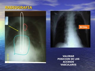 RADIOGRAFIA VALORAR POSICION DE LOS ACCESOS VASCULARES BCIAo 