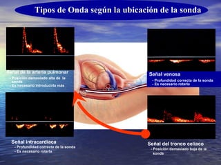 Tipos de Onda según la ubicación de la sonda Señal venosa  - Profundidad correcta de la sonda  - Es necesario rotarla Señal intracardiaca  - Profundidad correcta de la sonda  - Es necesario rotarla Señal de la arteria pulmonar - Posición demasiado alta de  la sonda - Es necesario introducirla más Señal del tronco celíaco   - Posición demasiado baja de la sonda 