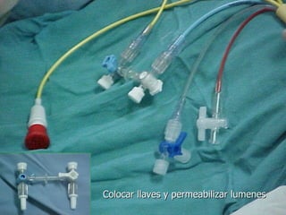 Colocar llaves y permeabilizar lumenes 