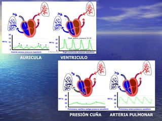 AURICULA VENTRICULO PRESIÓN   CUÑA ARTERIA PULMONAR 
