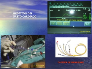 MEDICION DEL GASTO CARDIACO CATETER DE SWAN GANZ   