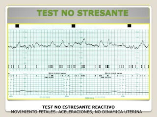 TEST NO STRESANTE

TEST NO ESTRESANTE REACTIVO
MOVIMIENTO FETALES. ACELERACIONES, NO DINAMICA UTERINA

 
