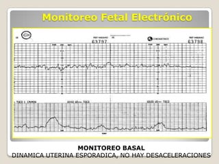 Monitoreo Fetal Electrónico

MONITOREO BASAL
DINAMICA UTERINA ESPORADICA, NO HAY DESACELERACIONES

 