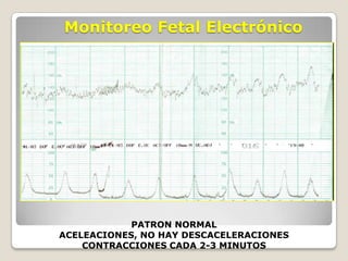 Monitoreo Fetal Electrónico

PATRON NORMAL
ACELEACIONES, NO HAY DESCACELERACIONES
CONTRACCIONES CADA 2-3 MINUTOS

 