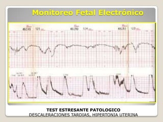 Monitoreo Fetal Electrónico

TEST ESTRESANTE PATOLOGICO
DESCALERACIONES TARDIAS, HIPERTONIA UTERINA

 