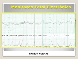 Monitoreo Fetal Electrónico

PATRON NORMAL

 