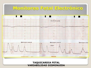 Monitoreo Fetal Electrónico

TAQUICARDIA FETAL
VARIABILIDAD DISMINUIDA

 