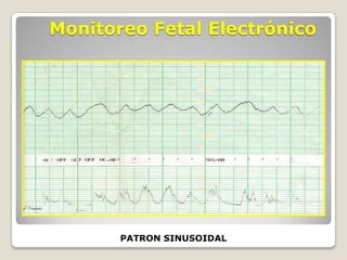 Monitoreo Fetal Electrónico

PATRON SINUSOIDAL

 